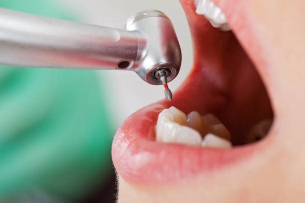 Best Knocked-Out Tooth (Avulsed Tooth) Treatment in Cave Junction, OR